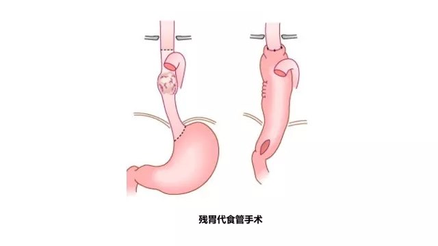 食管癌合并胃癌如何手术治疗?什么是食管胃双原发癌?