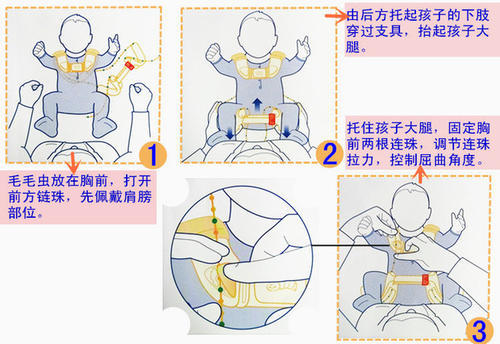 髋关节发育不良对婴儿来说到底意味着什么?