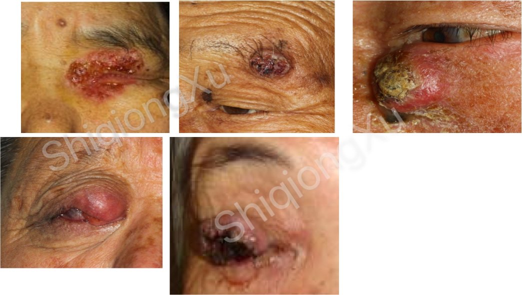 眼睑肿瘤系列之眼睑恶性肿瘤常见的有哪几种看图鉴别你是哪一种
