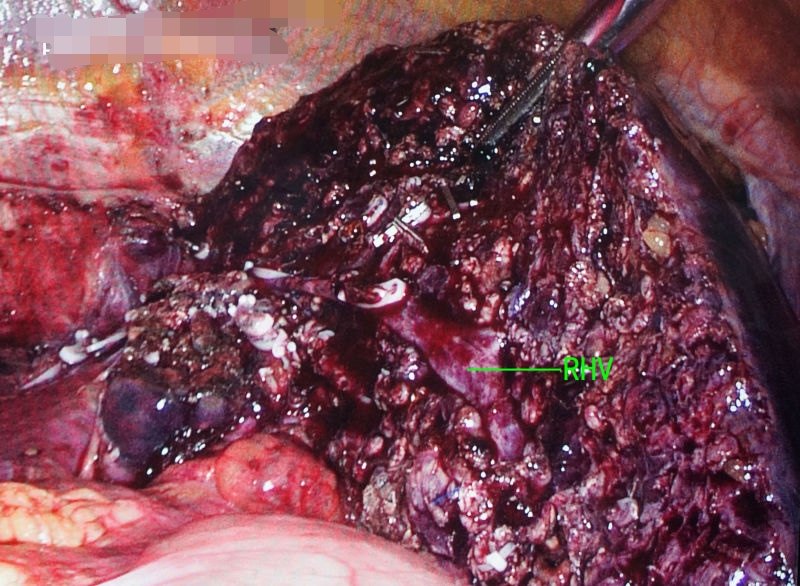 腹腔镜肝脏切除治疗肝脏肿瘤的微创利器