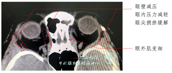 graves眼病系列病例④眼眶减压手术之三壁减压