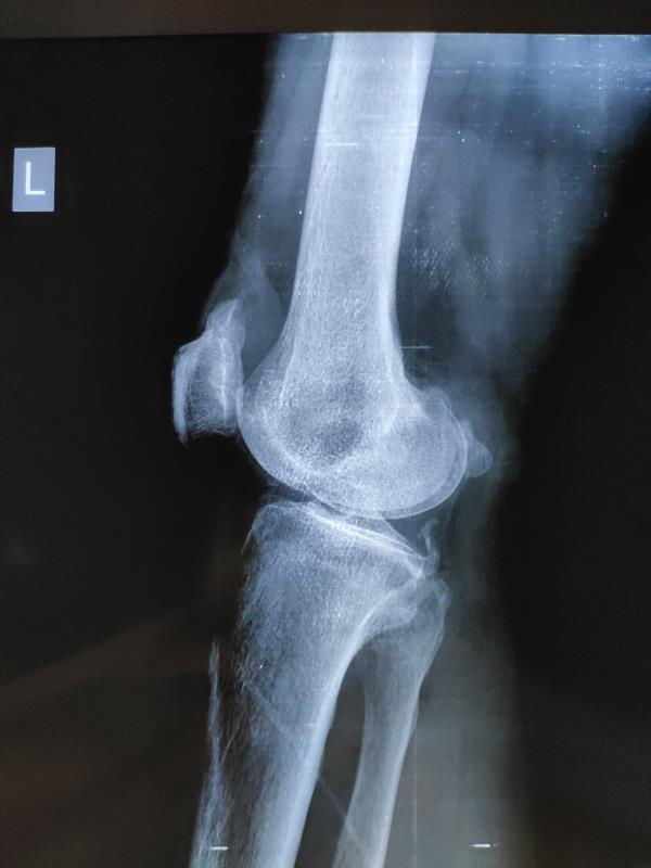 术后x线显示膝关节内游离体全部取出 3,膝关节半月板损伤