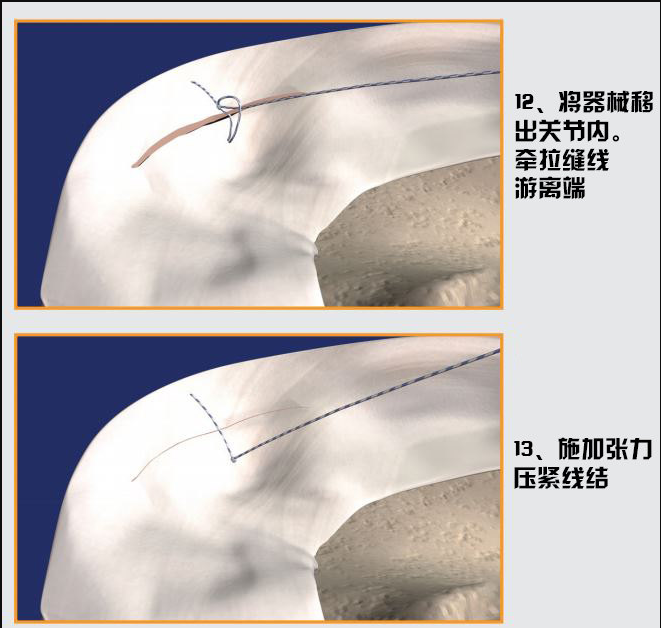 半月板缝合全内(all-inside)技术解读