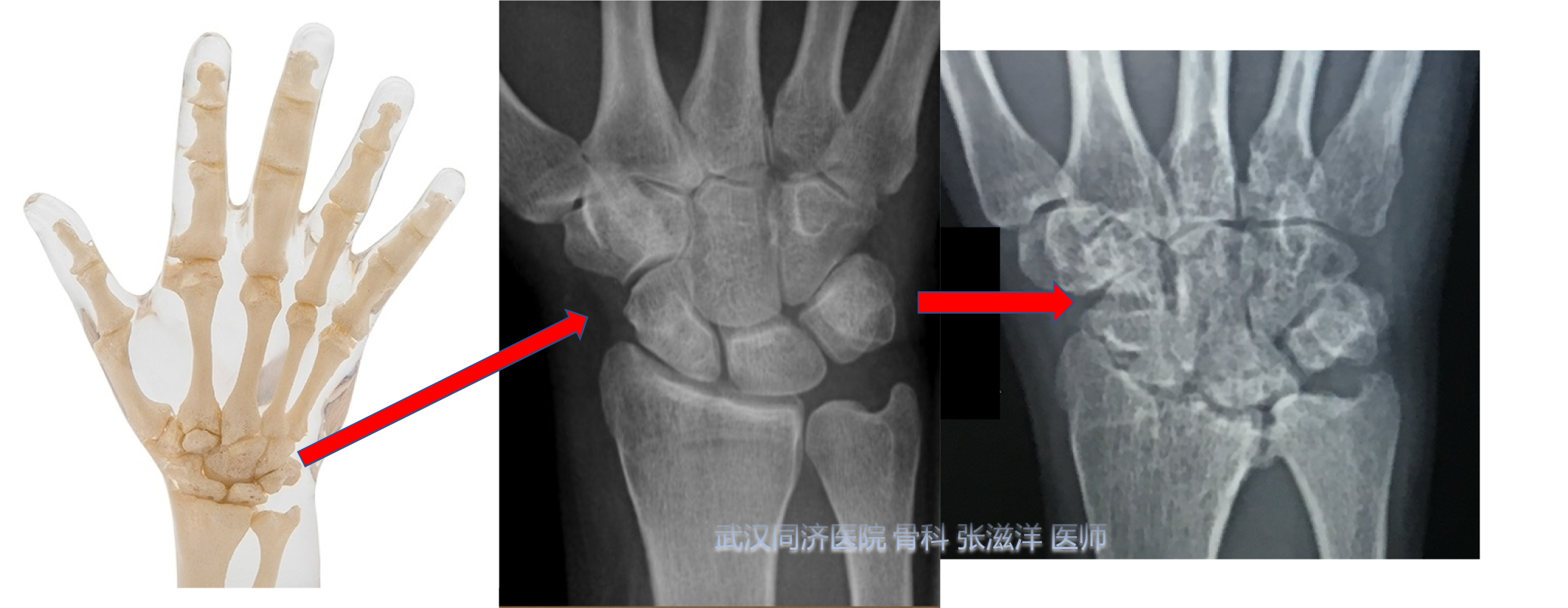 手腕部疼痛的一个常见原因腕部滑膜炎