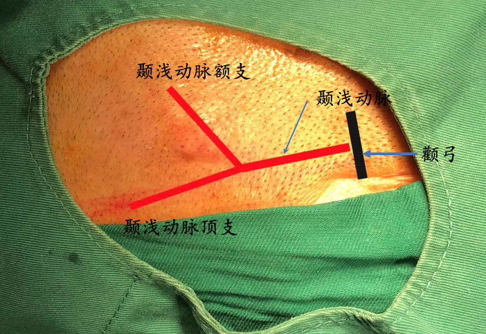 颞浅动脉结扎术治疗顽固性血管性头痛