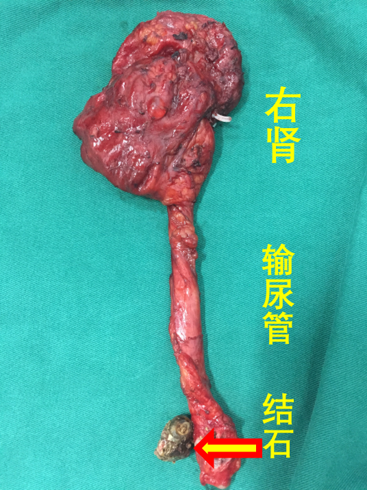 定期体检,早发现,早治疗!_肾结石