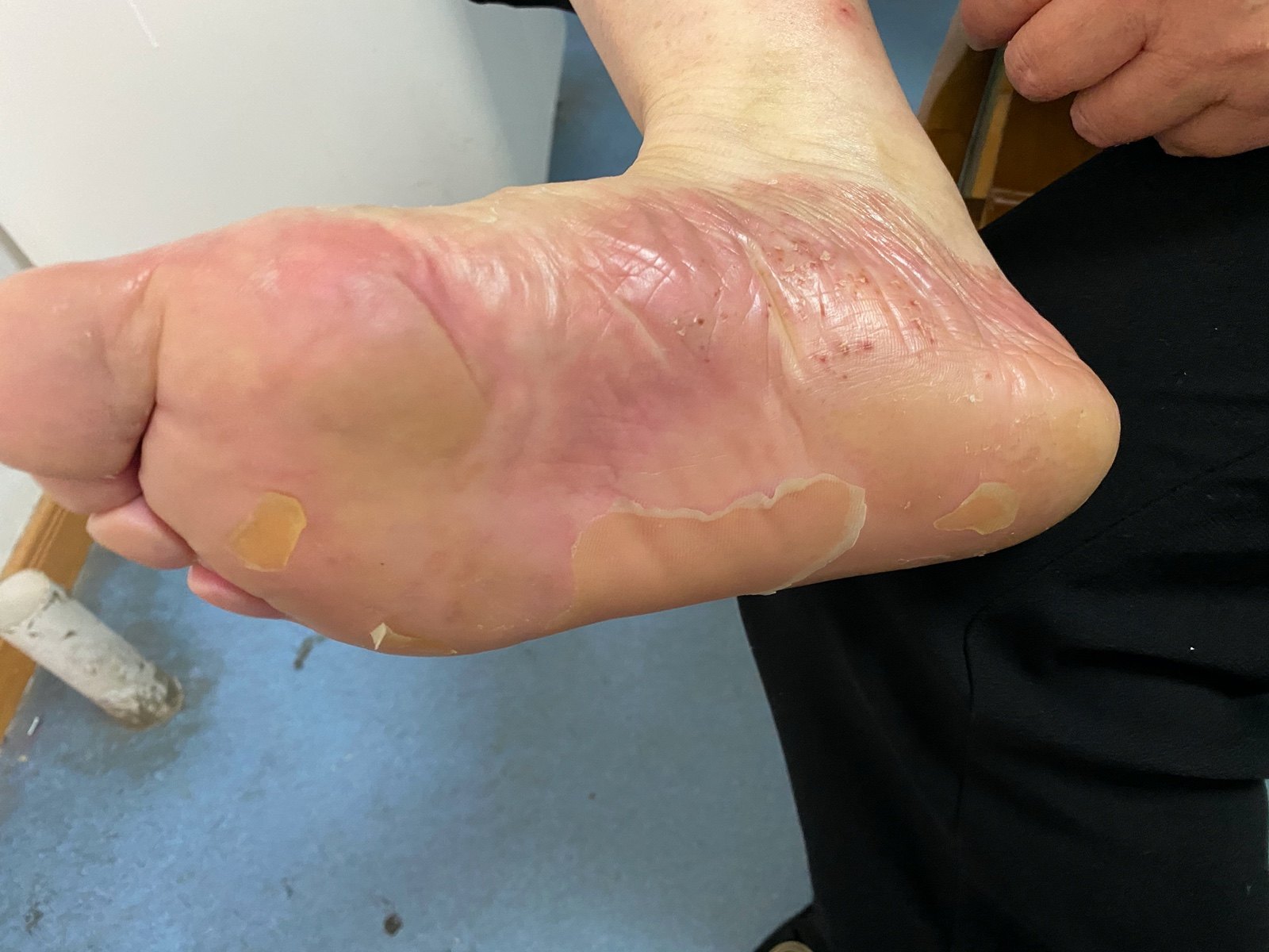 掌跖脓疱病临床治疗案例