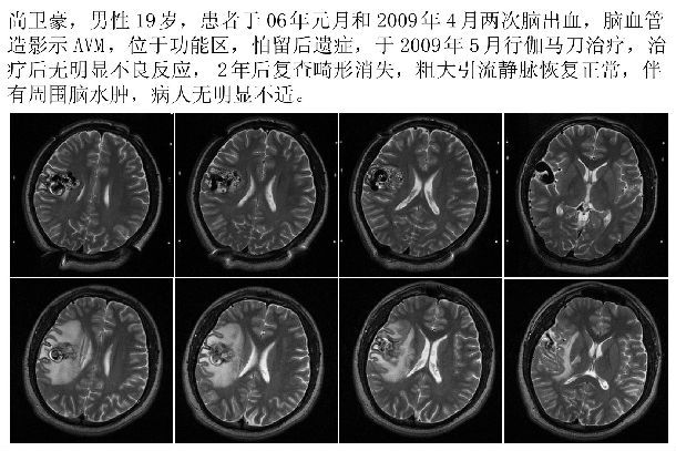 通俗讲解伽玛刀原理