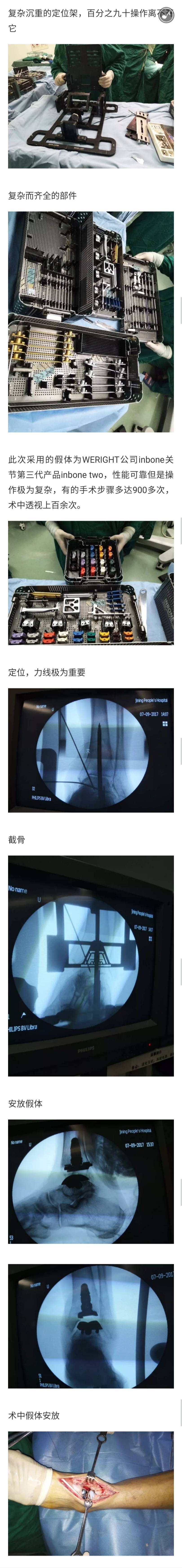 我院完成鲁西南首例踝关节置换