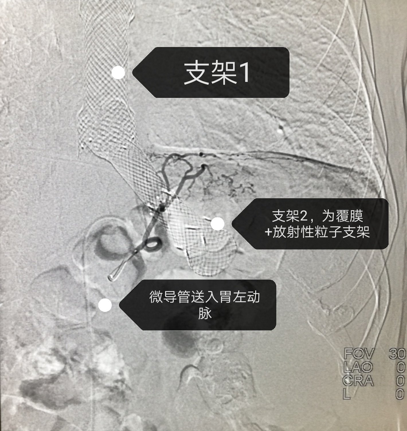 80岁胃癌贲门梗阻并气管瘘治疗1例分享