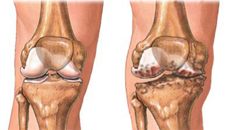 膝关节骨性关节炎是指由于膝关节软骨变性,骨质增生而引起的一种慢性