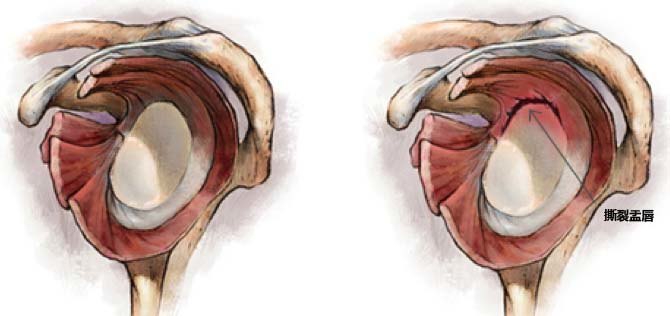 不是所有的肩部疼痛都叫肩周炎三盂唇撕裂