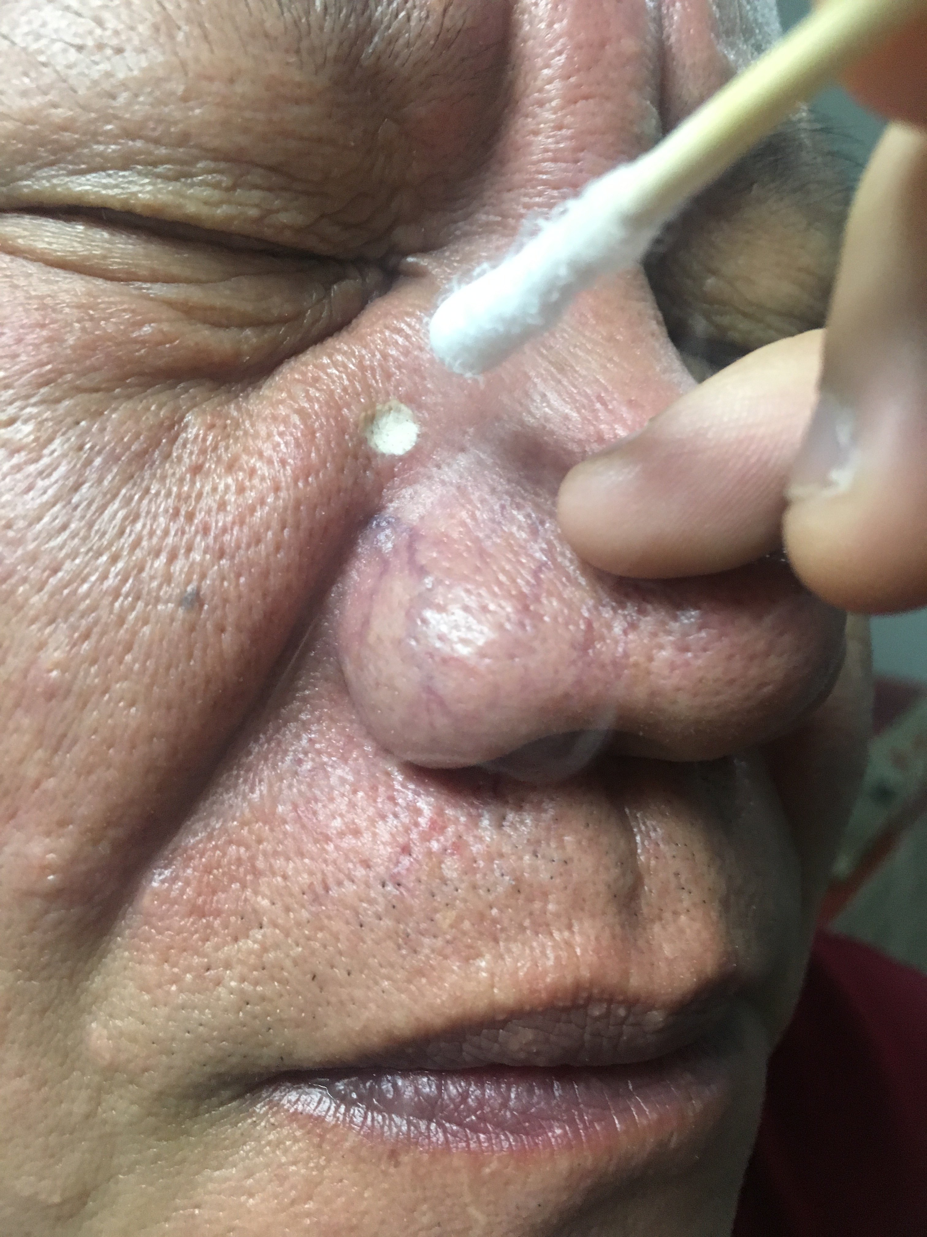 老年性皮脂腺增生1例