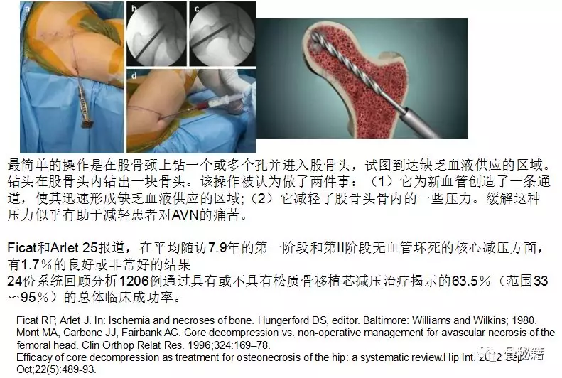 钻孔减压(核心技术)rf:风险因素 onfh:股骨头坏死 fh:股骨头 mri