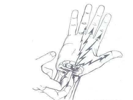 叩击试验(tinel征):用手指沿正中神经走形叩击腕掌部,如手部正中神经