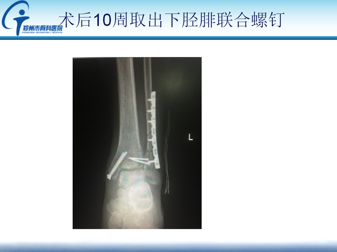 踝关节骨折术后下胫腓骨性连接原因分析