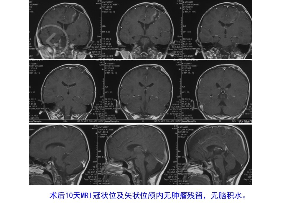 神经内镜经endoport技术切除5岁儿童侧脑室肿瘤1例