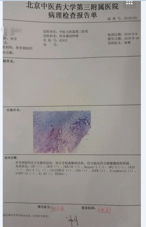 胰腺癌梗阻性黄疸合并肝硬化胆道引流1例分享