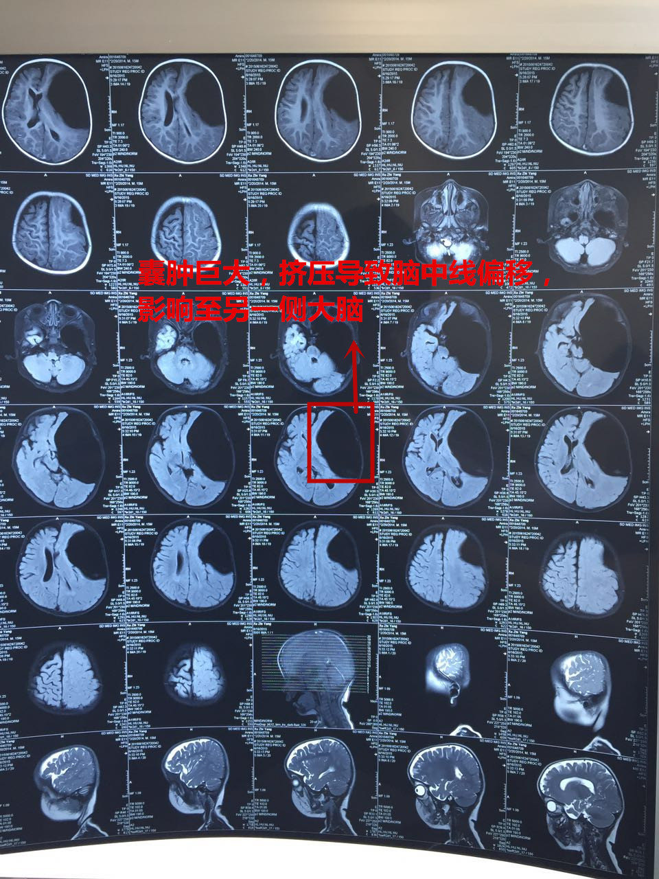 蛛网膜囊肿