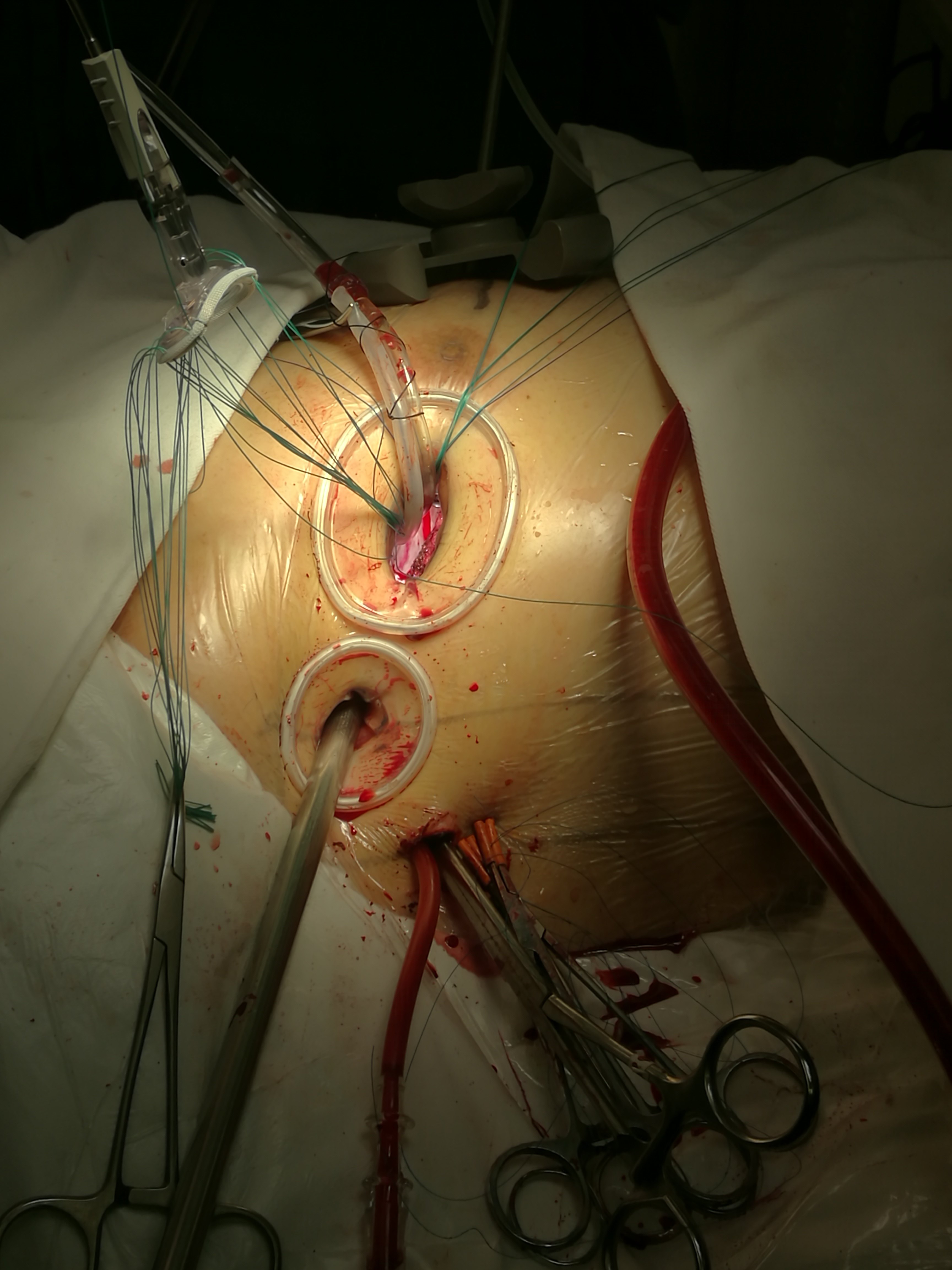 全胸腔镜二尖瓣修复手术