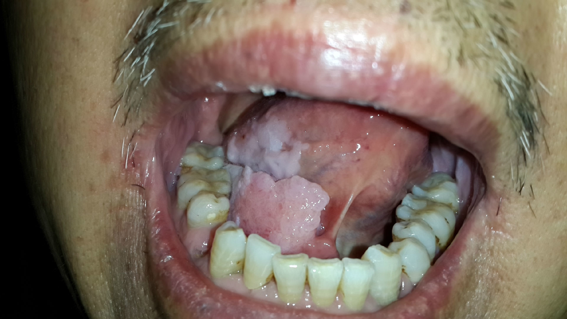 右侧舌口底乳头状瘤