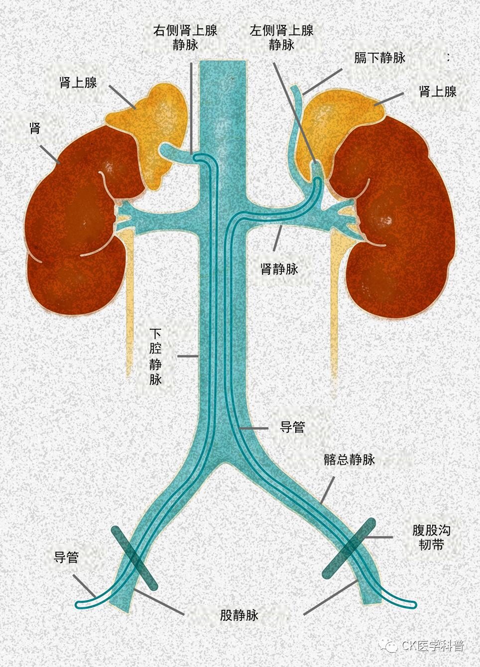 继发性高血压的特殊类型原发性醛固酮增多症