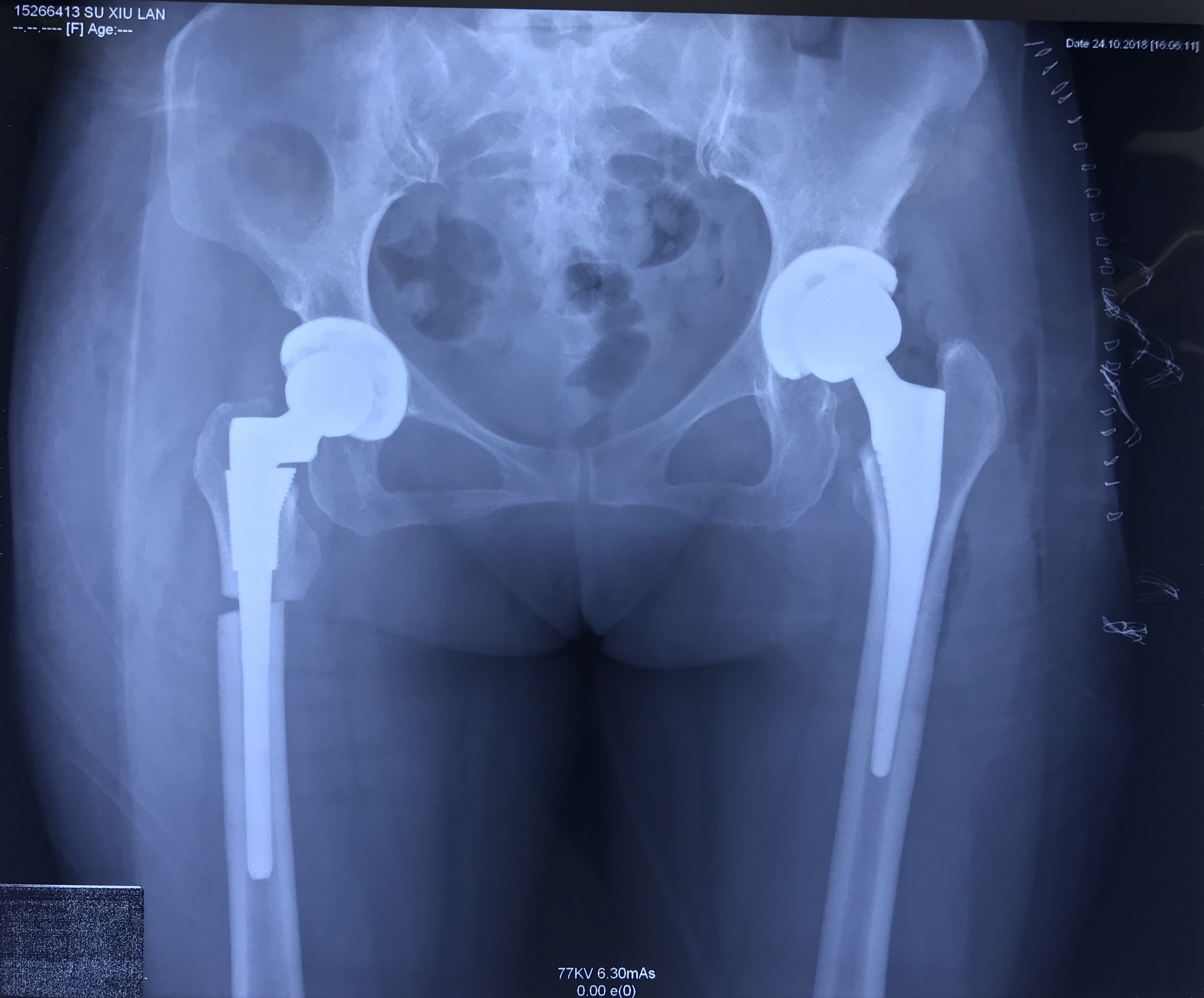 病例 4 64岁女性,四型髋关节发育不良,合并骨质疏松,大骨节病,s-rom