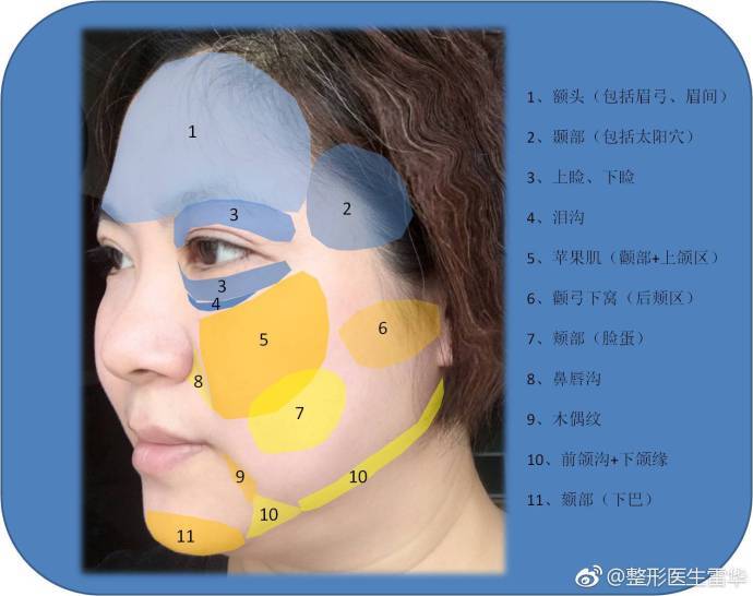 面部皮下脂肪的分布 面部脂肪移植的层次&吸脂修复层次深黄色区域