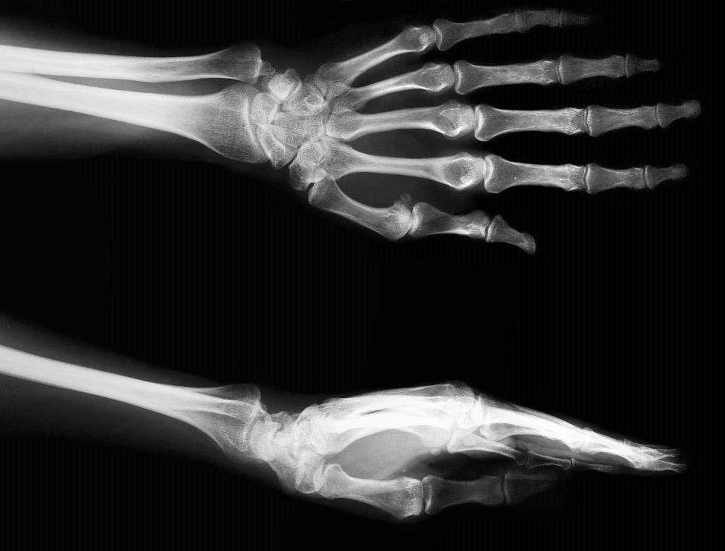 1.  x线:主要是为了初步除外腕部的骨折,畸形及占位病变等情况.