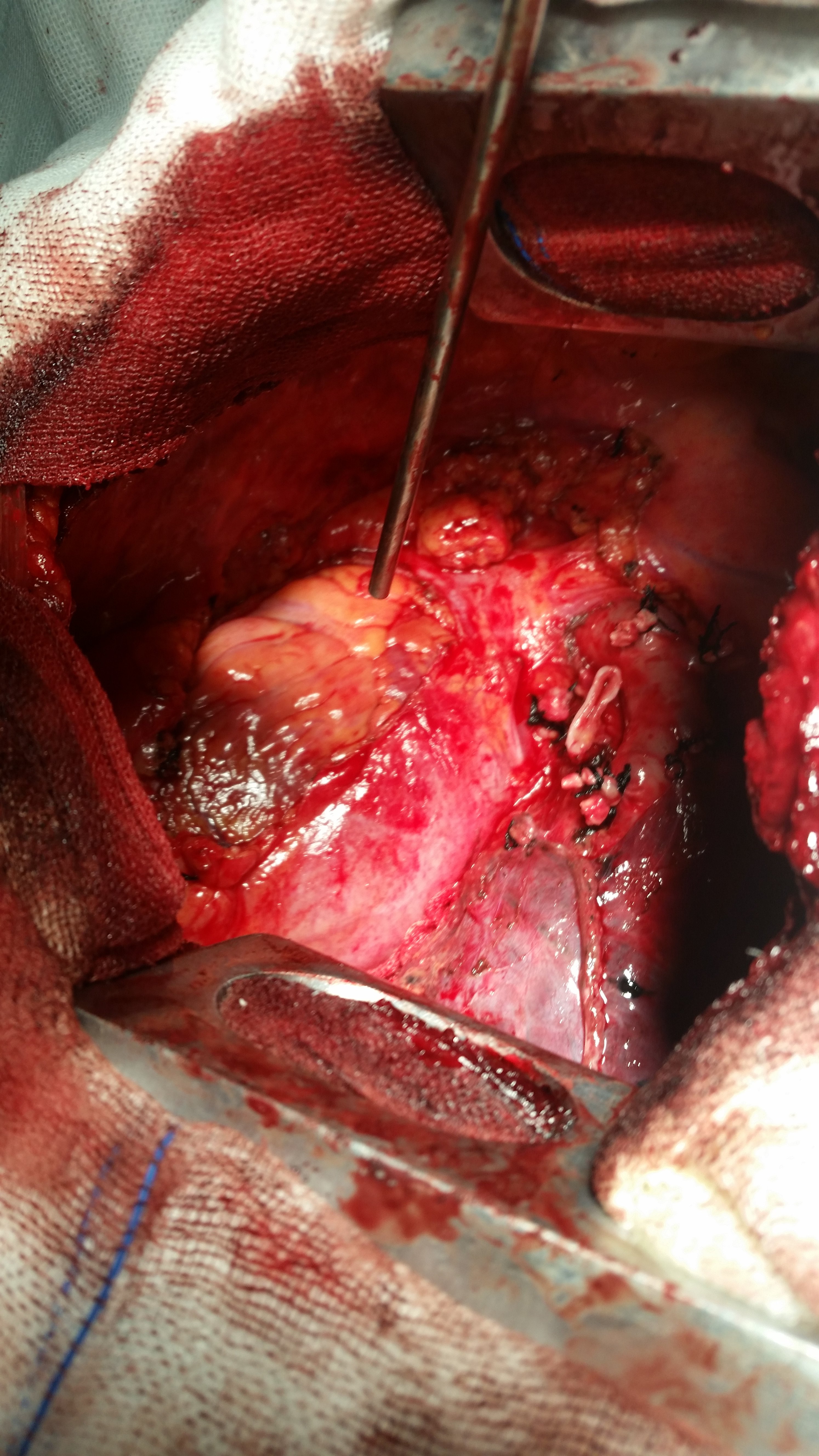 在菏泽某县医院成功肺癌根治术心包切除疝补片