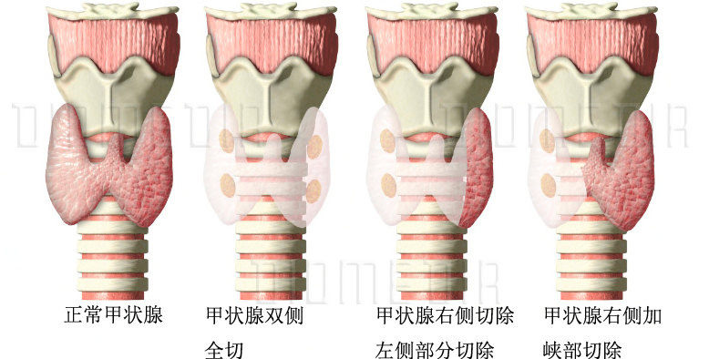 目前,对原发肿瘤在1厘米以下的,局限于一侧腺叶内的单发甲状腺微小