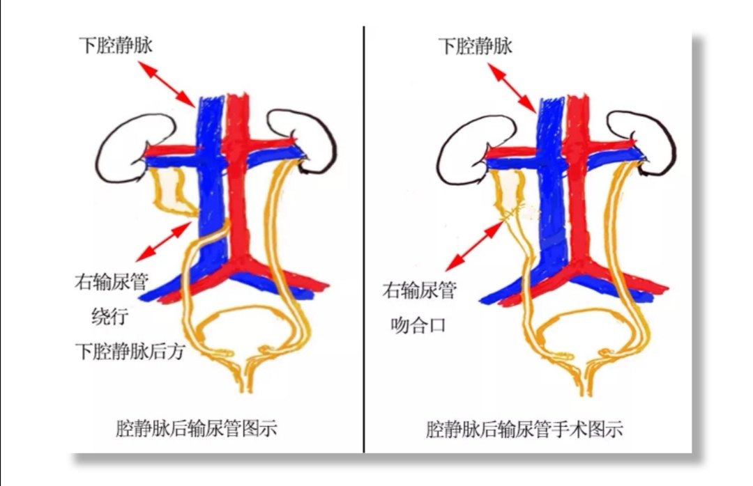 双镜联合同期处理腔静脉后输尿管合并肾结石