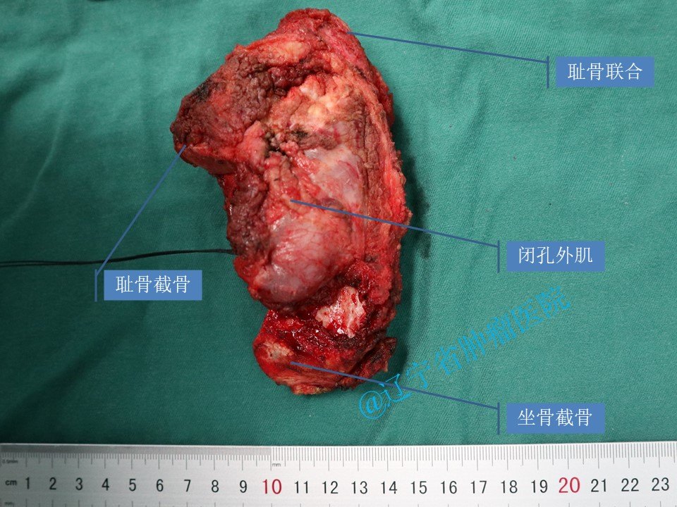 骨盆尤文肉瘤手术病例