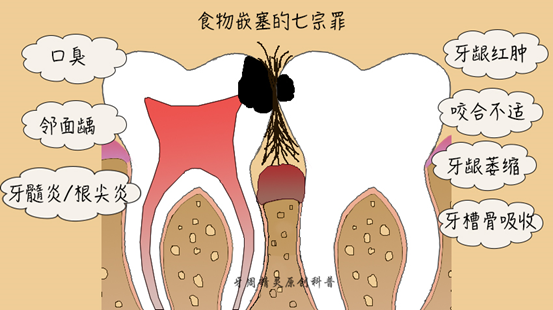 食物嵌塞之七宗罪