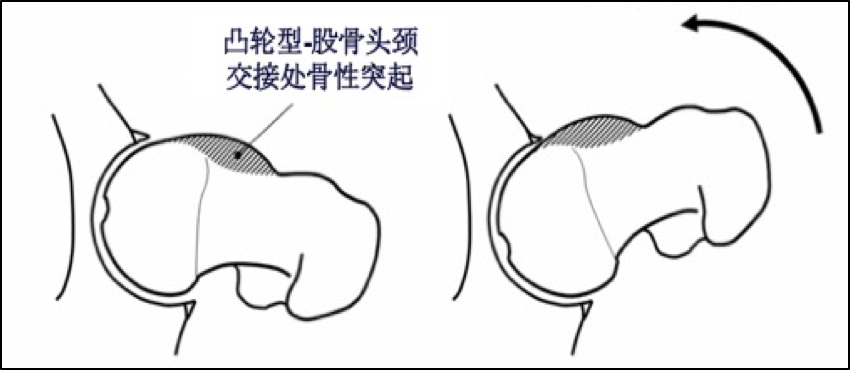 股骨髋臼撞击症健康宣教1带您认识股骨髋臼撞击症