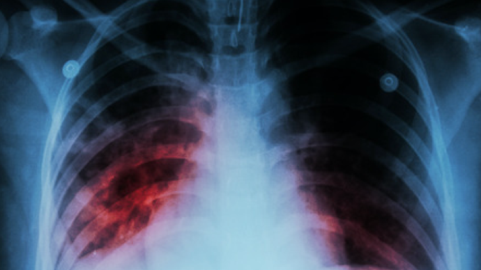 体检发现肺局部纤维灶会演变成肺纤维化吗?