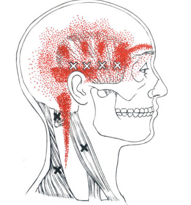 这些牵涉疼痛密集的时候可延伸至头部的一侧,集中在颞骨部及眼眶的后