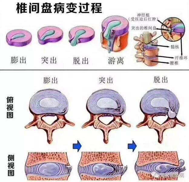 什么是腰椎间盘突出症?这病又是怎么发生的呢?