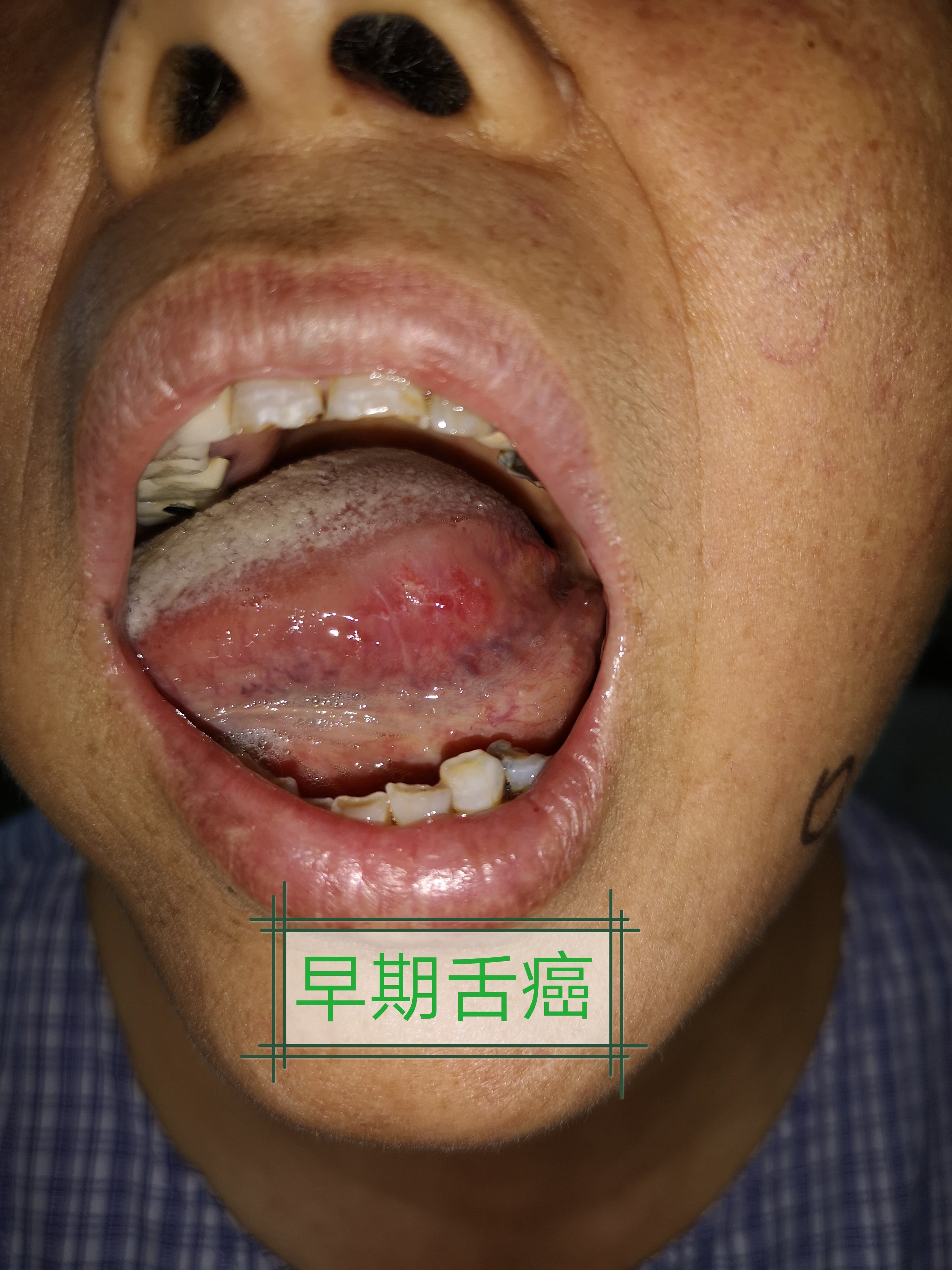 史,部分患者与牙齿残根,烂牙,不良修复体等长期慢性刺激,也可由舌白斑