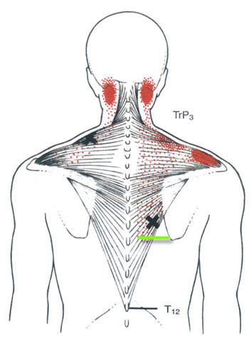 图注:右侧下斜方肌的中央性第三激痛点(x)及牵涉痛.