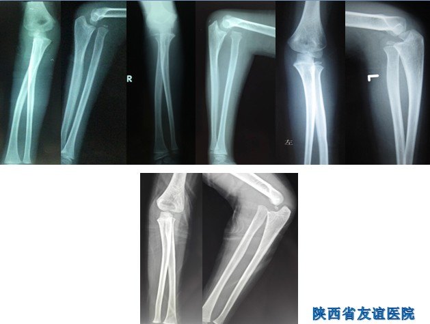 四种尺骨旋转截骨方法治疗难治性肱桡脱位