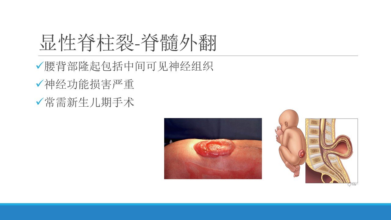 脊柱裂的常见类型及治疗原则