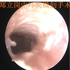 外耳道胆脂瘤并发外耳道狭窄小切口微创手术第892广东