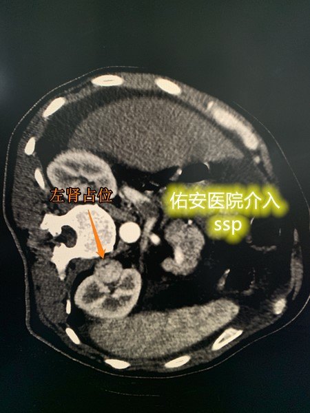 男性,体检发现左肾上极占位