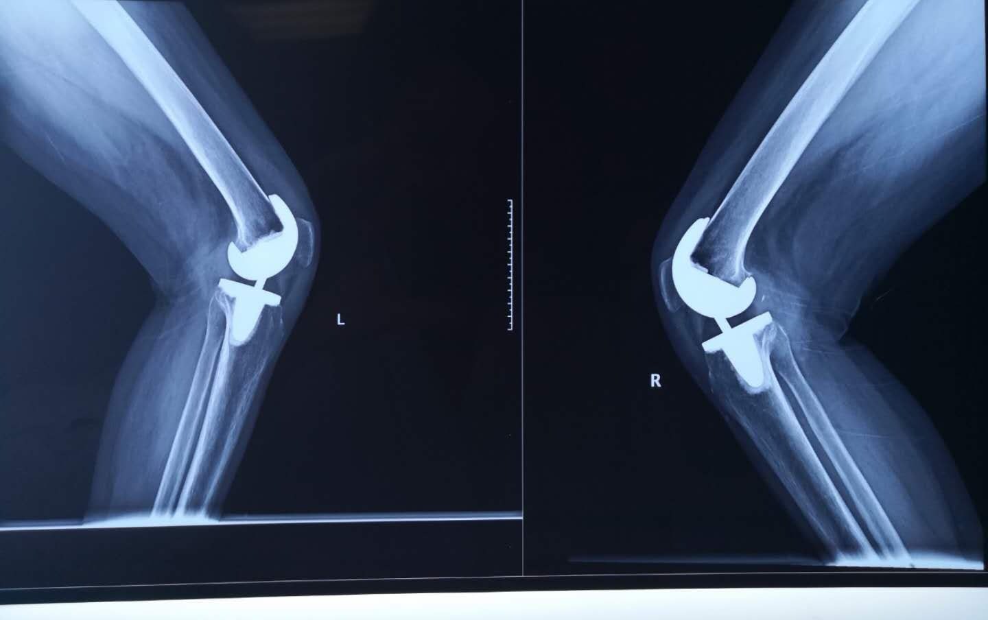 术后双膝关节正位x片可见关节骨赘清除彻底,双下肢力线良好.