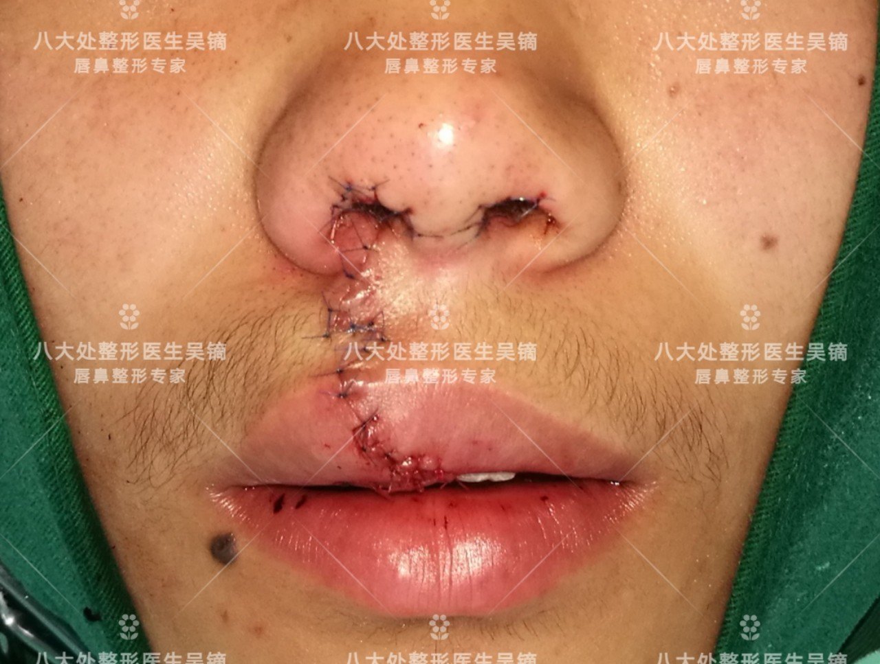 吴镝 唇裂二期的整形美容修复(多案例分享)  由于孩子原来唇裂的程度