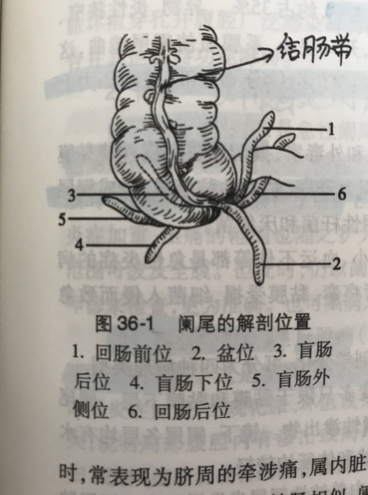 急性阑尾炎疼起来什么样