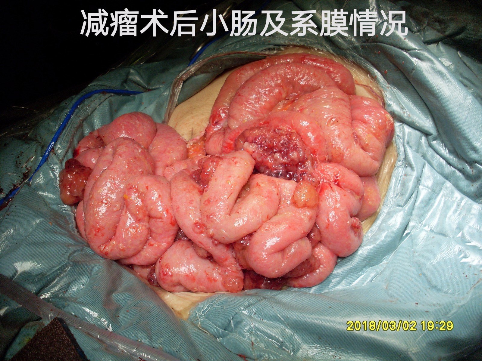 7腹腔镜探查,子宫附件正常,阑尾6×1.