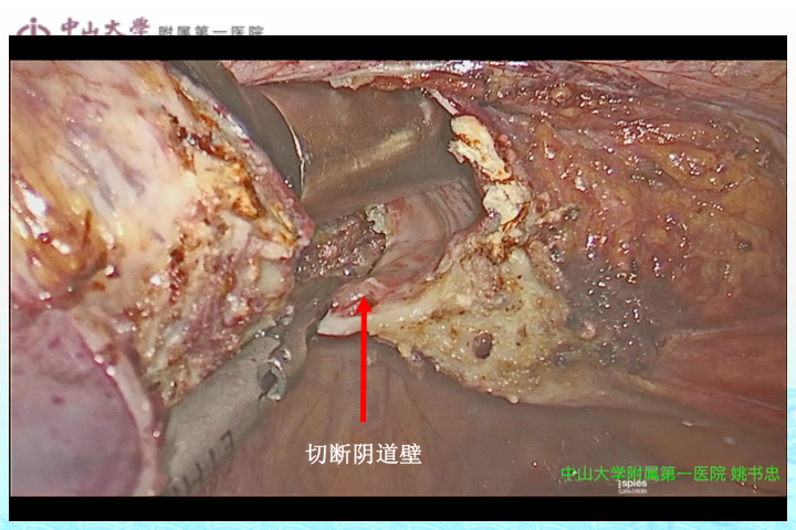 你应该了解的腹腔镜子宫切除术