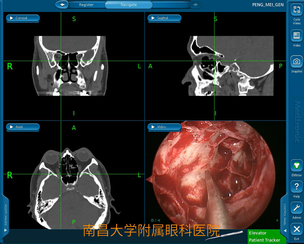 术中导航引导,精准定位眶尖部肿瘤位置,内镜下经鼻腔摘除眶尖部小肿瘤